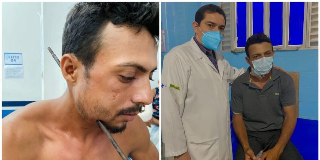 Ferro de arma caseira atravessa o pescoço de trabalhador: "sou um milagre"