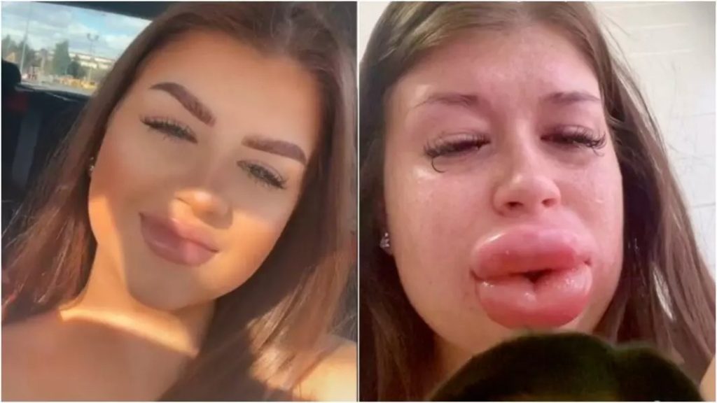 Jovem decide remover preenchimento labial e acaba ficando totalmente irreconhecível