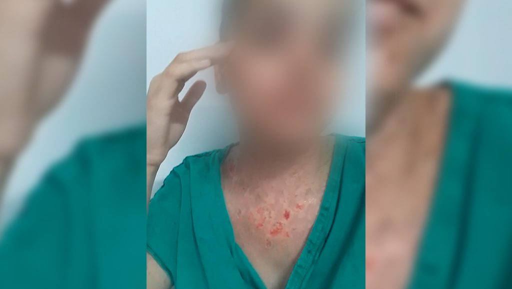 Fogão a lenha explode e deixa jovem de Anápolis com o corpo queimado