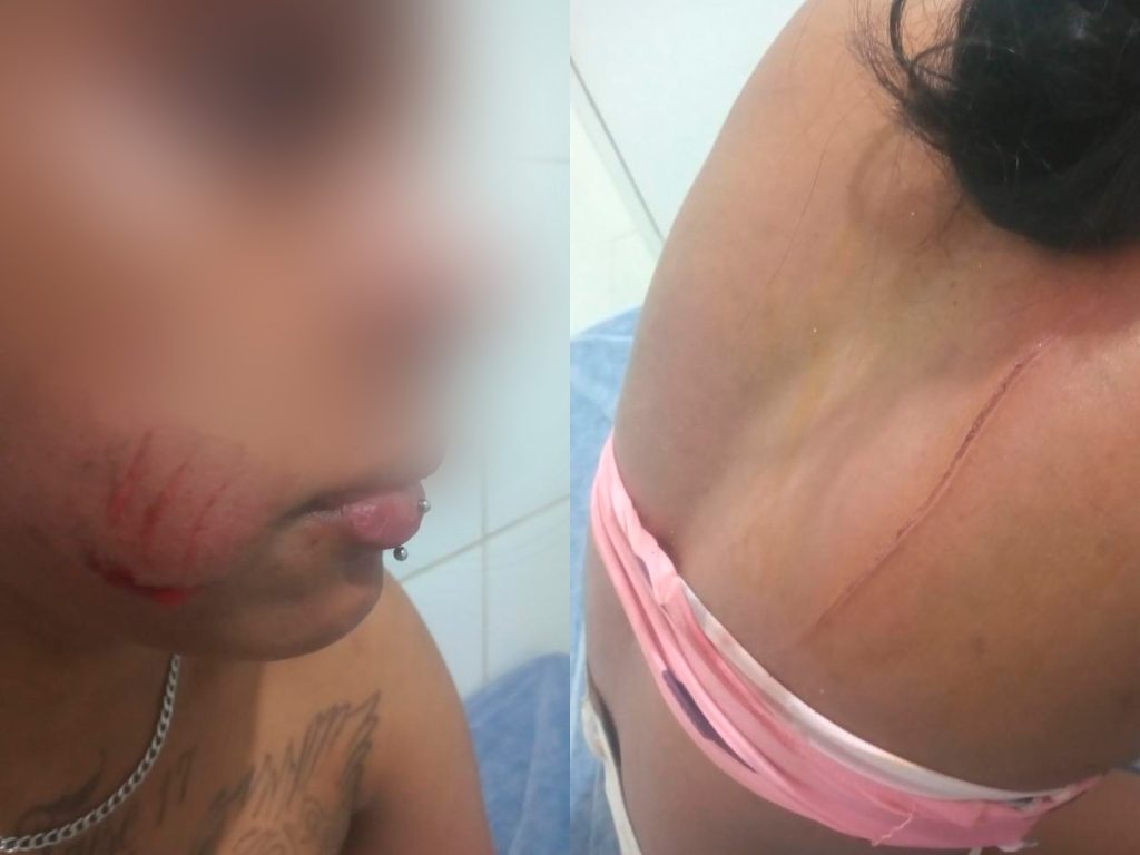 Mulher faz a ex parar na UPA após encontrar ela no bar e decidir cair de boca