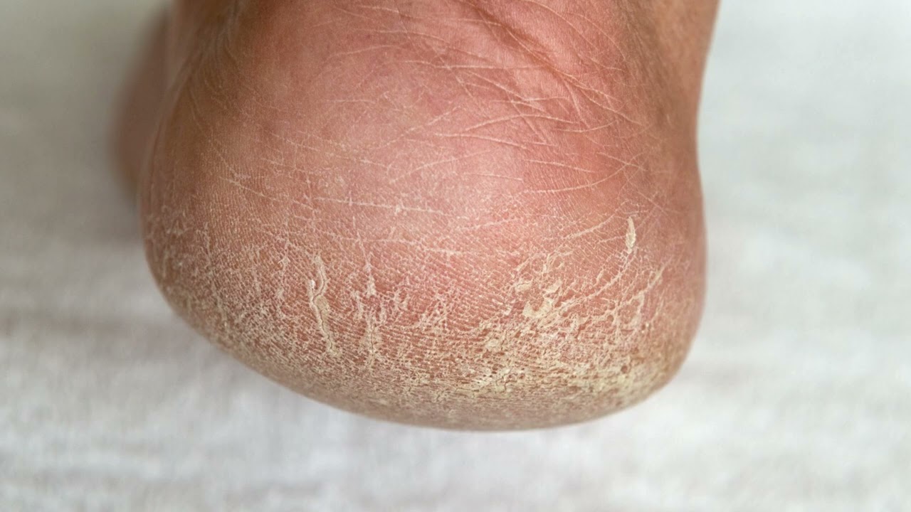 6 dicas para cuidar da pele durante o tempo e evitar ressecamento