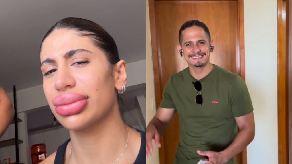 Influencer de Goiânia viraliza ao surpreender irmão com resultado de “prenchimento nos lábios”