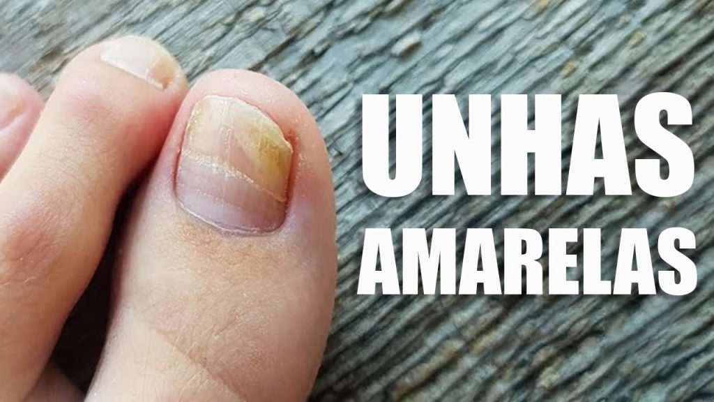 6 sinais de doenças mortais que aparecem nas suas unhas e nem todo mundo sabe