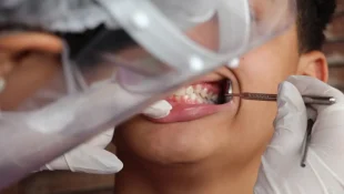 Brasil tem 45% de cobertura em saúde bucal; meta é chegar a 70%