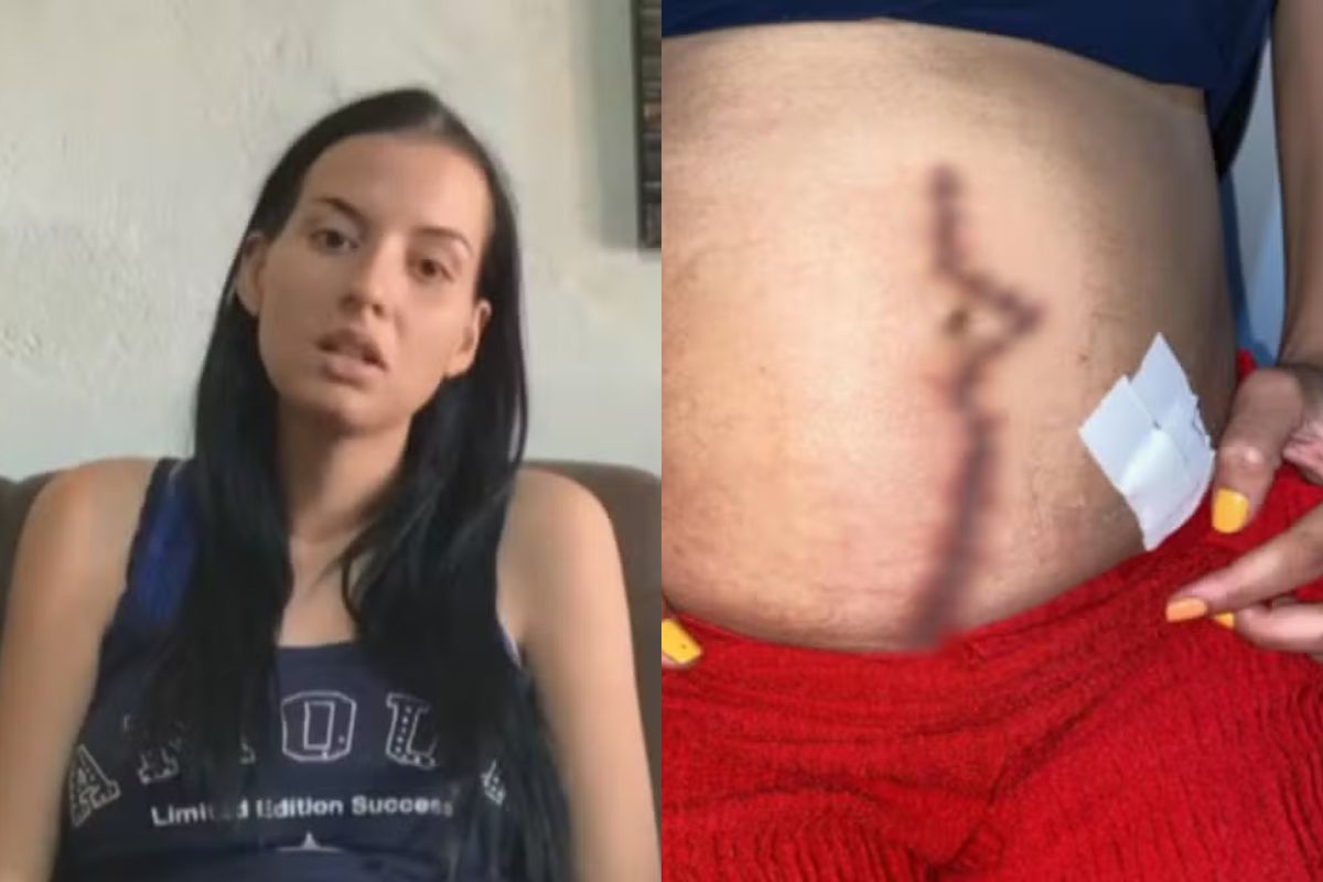 Jovem goiana vive meses de terror após ter gaze esquecida dentro do corpo em cesariana