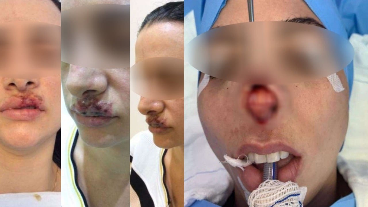 Antes e depois: PC divulga imagens de pacientes que tiveram rostos deformados em clínica Karine Gouveia