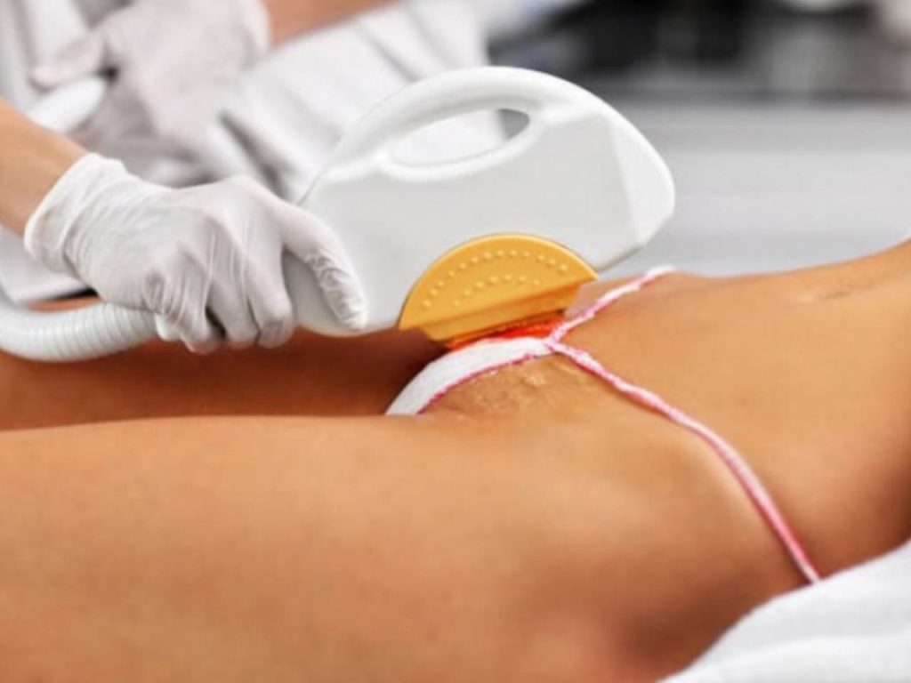 Depiladora causa polêmica após cobrar taxa extra de cliente em depilação íntima