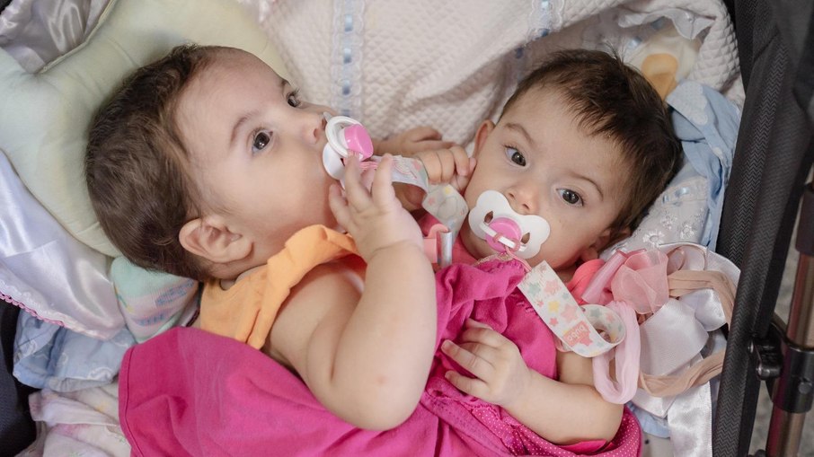 Antes e depois de gêmeas siamesas separadas em Goiânia após 19h de cirurgia