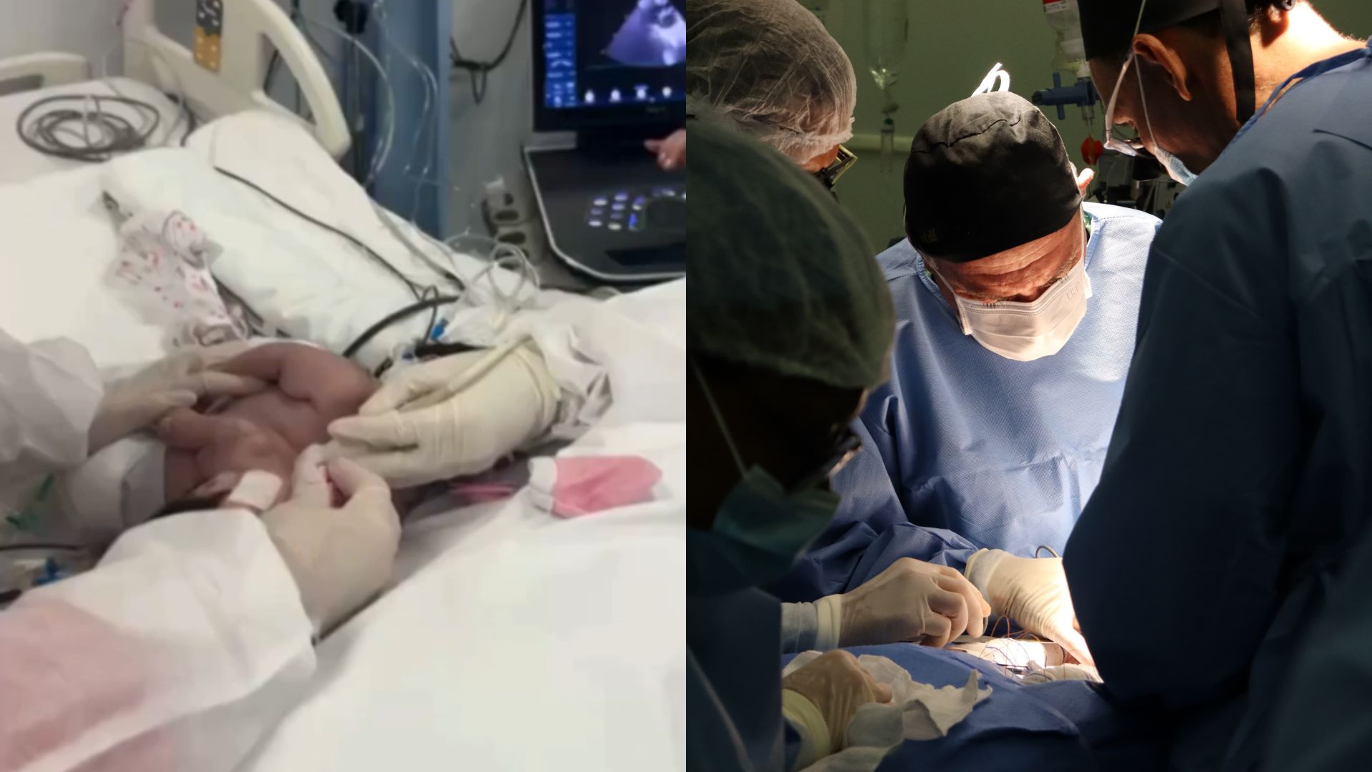 Siamesas com apenas 34 dias de vida passam por cirurgia de separação em Goiânia
