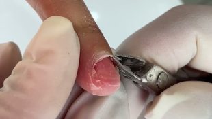 unhas quebradiças
