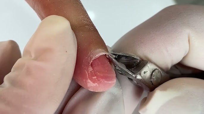 unhas quebradiças