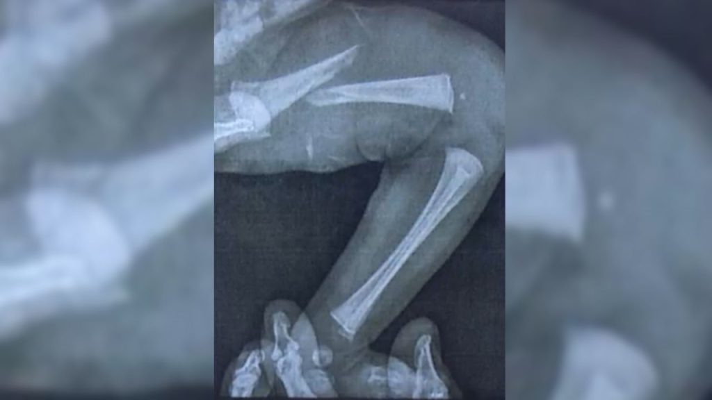 Bebê teve fêmur quebrado após fazer exame em Aparecida de Goiânia. (Foto: Reprodução/TV Anhanguera)