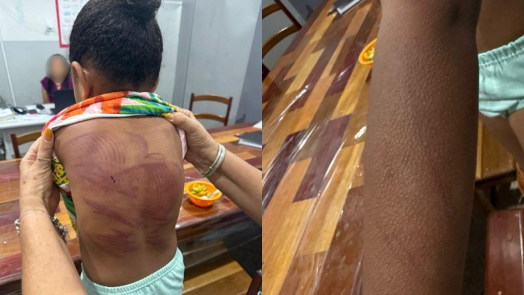 Menina tinha vários sinais de hematomas realizados pelo padrasto. (Foto: Reprodução)