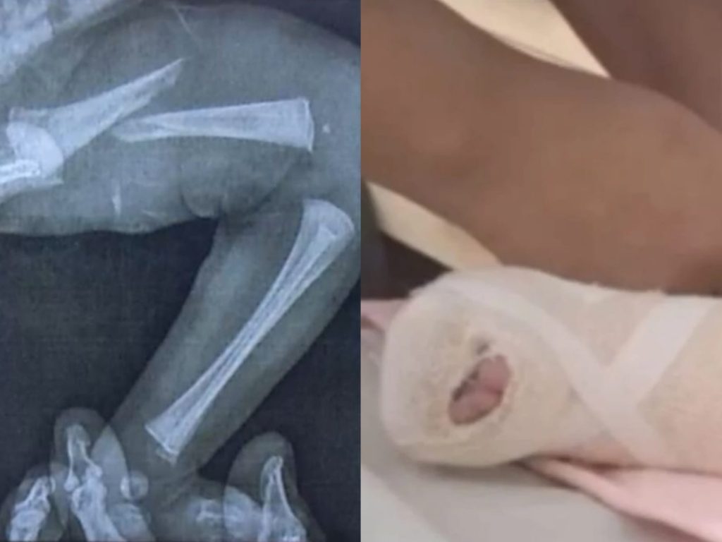 Bebê precisou utilizar gesso após a lesão. (Foto: Reprodução)
