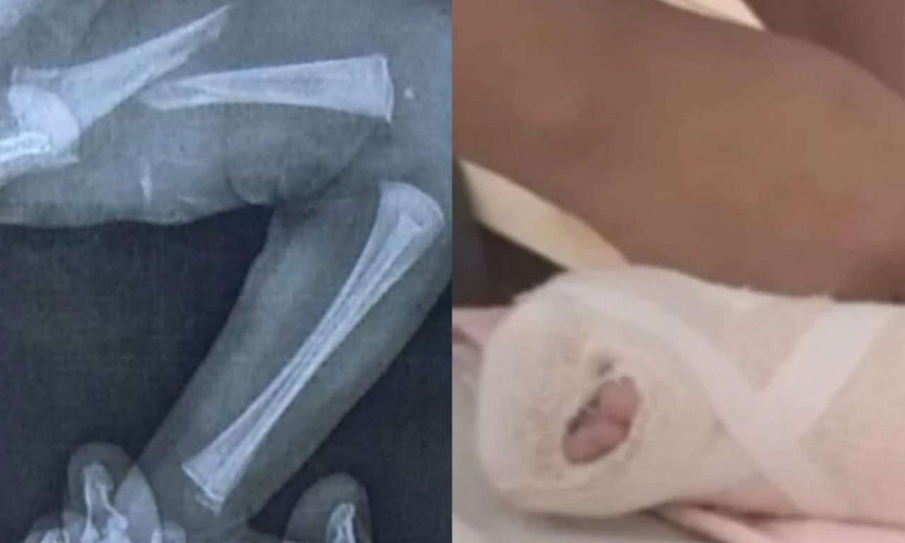 Bebê precisou utilizar gesso após a lesão. (Foto: Reprodução)