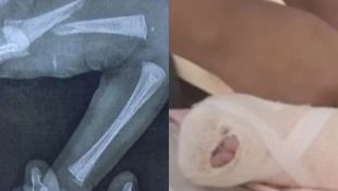 Bebê precisou utilizar gesso após a lesão. (Foto: Reprodução)