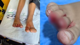 Criança precisou amputar o dedo após ser atacada por piranhas.