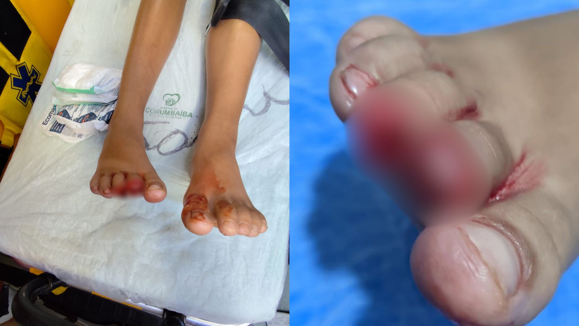 Criança precisou amputar o dedo após ser atacada por piranhas.