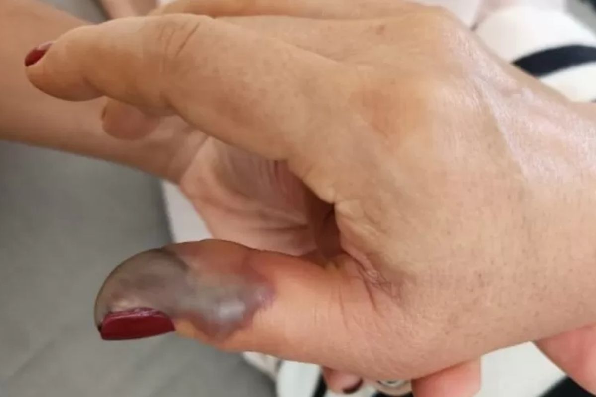 Idosa tem ponta do dedo necrosada após ir a salão de beleza em Goiânia