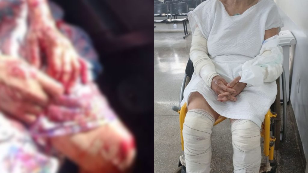 Idosa sofreu ferimentos graves após ser atacada por pitbull. (Foto: Acervo pessoal)