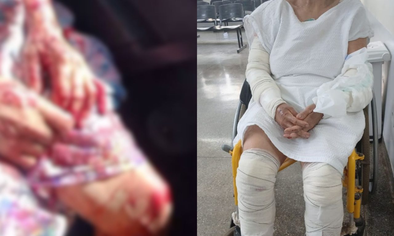 Idosa sofreu ferimentos graves após ser atacada por pitbull. (Foto: Acervo pessoal)