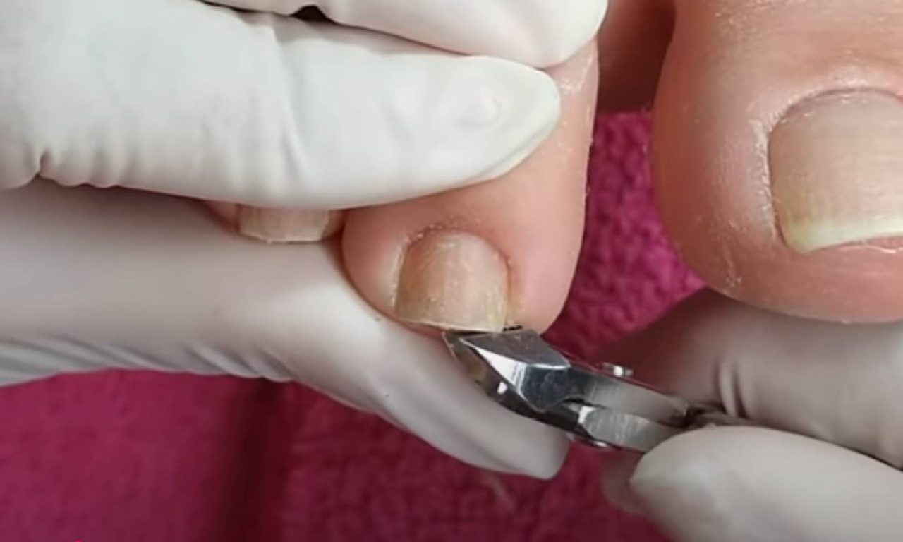 Por que cortar as unhas muito curtas pode ser prejudicial, segundo podólogos