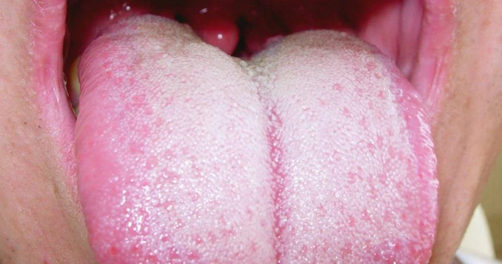 Língua branca pode ser sinal de doença