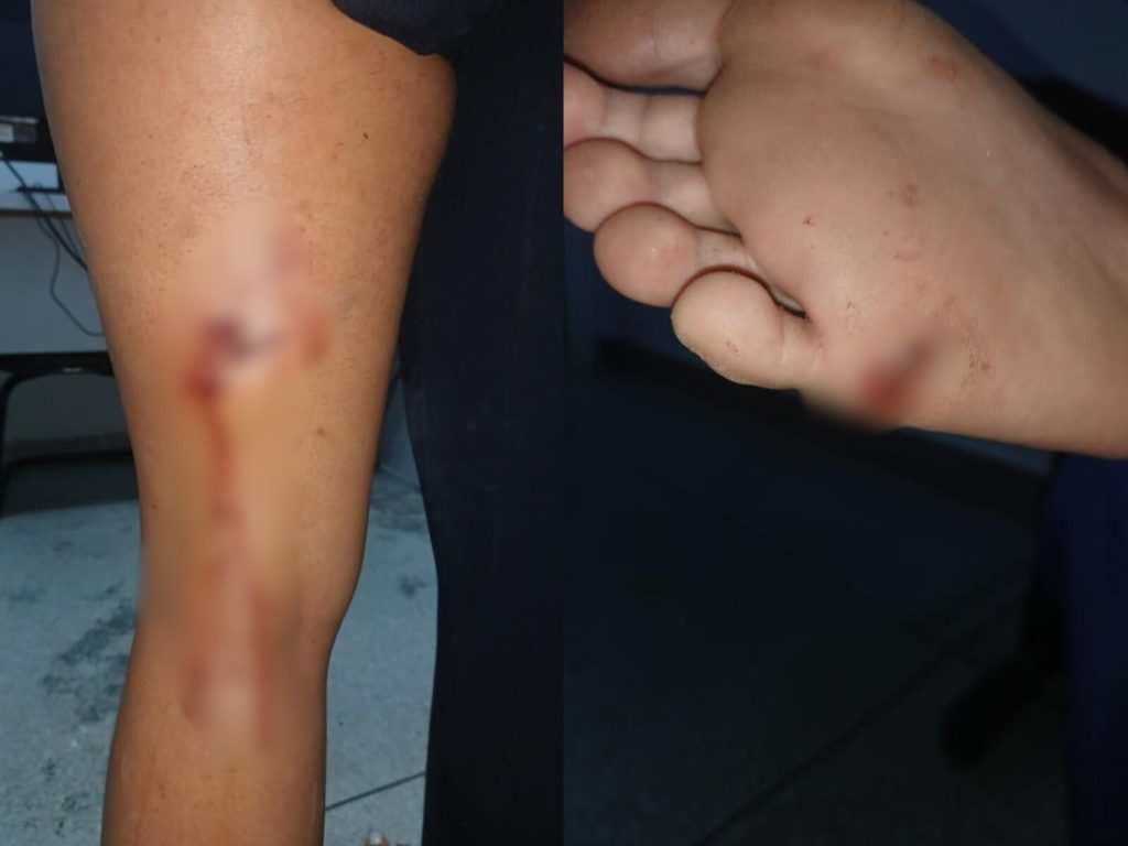 Marcas de mordidas e arranhões deixadas pelo pitbull. (Foto: reprodução)