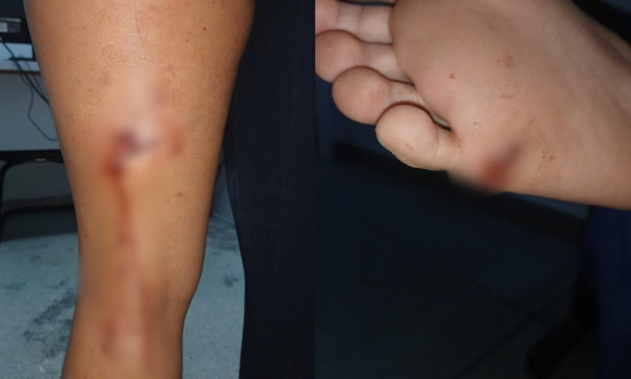 Marcas de mordidas e arranhões deixadas pelo pitbull. (Foto: reprodução)