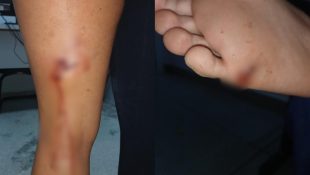 Marcas de mordidas e arranhões deixadas pelo pitbull. (Foto: reprodução)
