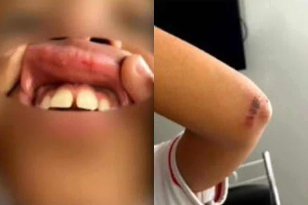 Criança é agredida com socos e tem dente quebrado por adolescentes dentro de colégio em Goiânia