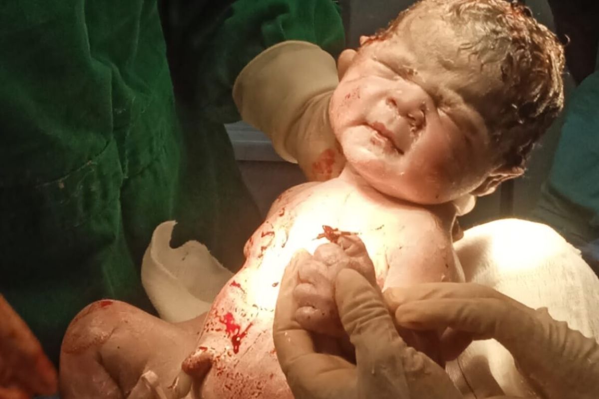 Bebê nasce segurando DIU da mãe durante parto raro em Nerópolis: “meu troféu de vitória”