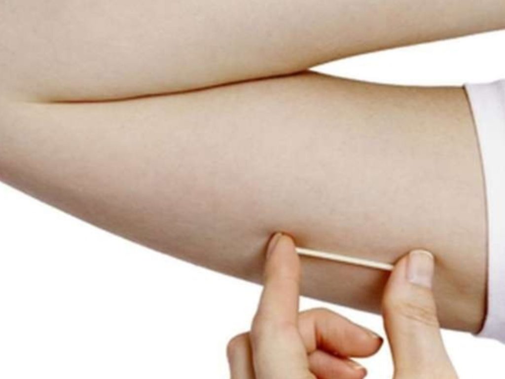 Implante contraceptivo deve ser ofertado por planos de saúde. (Foto: Reprodução)