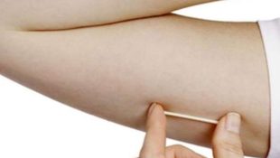Implante contraceptivo deve ser ofertado por planos de saúde. (Foto: Reprodução)