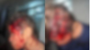 Mulher é esfaqueada na cabeça após briga com vizinha em Goiânia