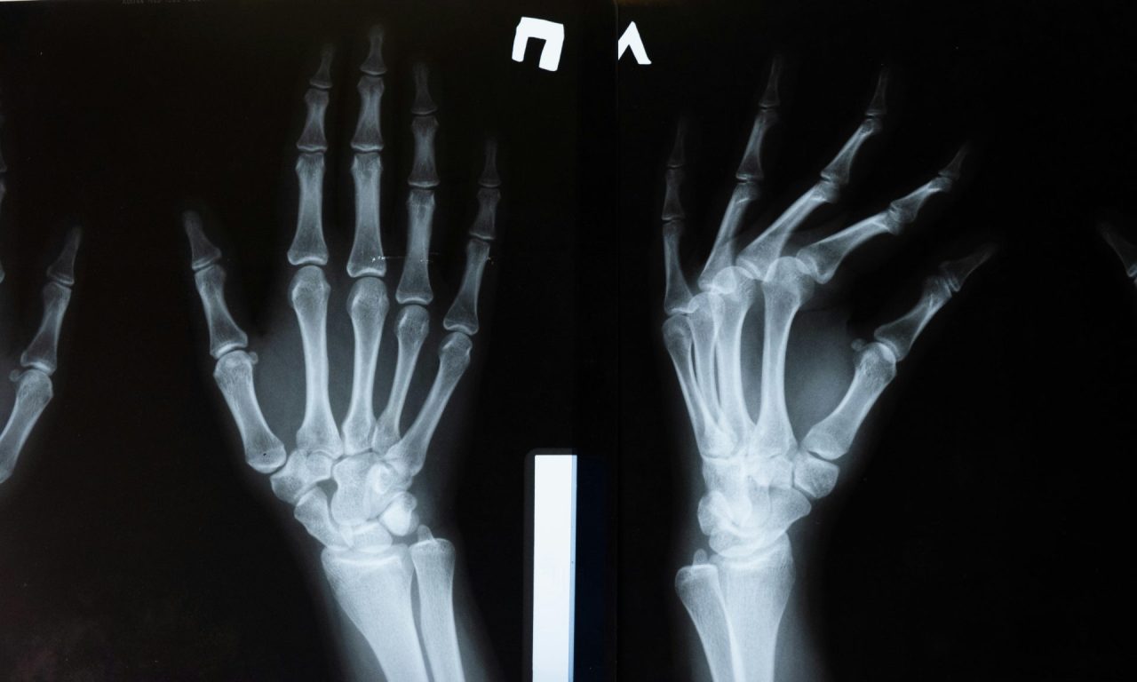 Cientistas descobrem método que pode reverter a progressão da osteoporose