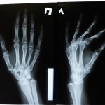 Cientistas descobrem método que pode reverter a progressão da osteoporose