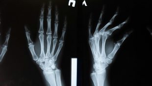 Cientistas descobrem método que pode reverter a progressão da osteoporose