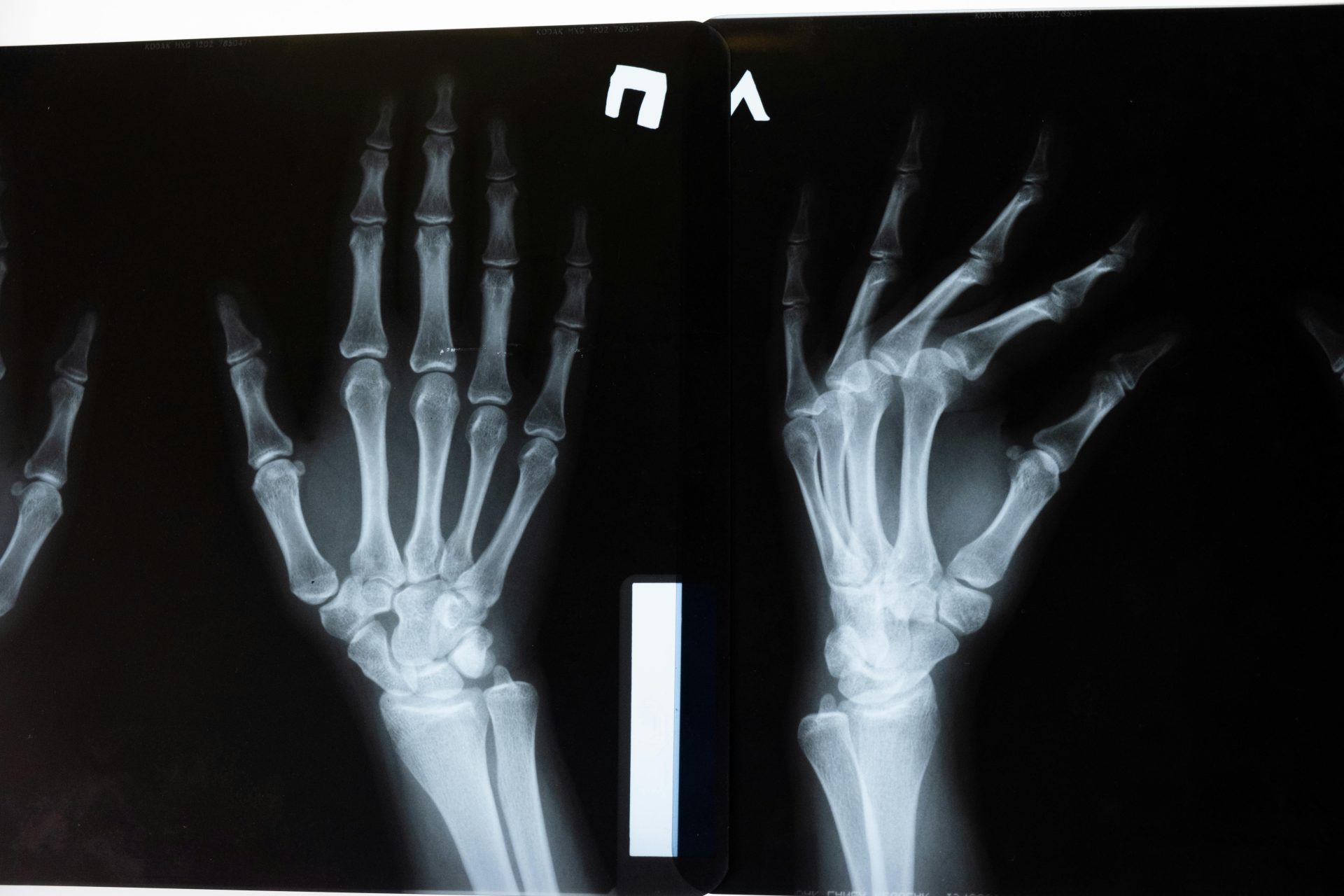 Cientistas descobrem método que pode reverter a progressão da osteoporose
