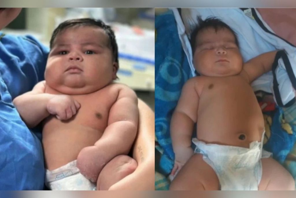 Bebê pesando 6,5 kg nasce de parto normal e mãe precisa levar 55 pontos