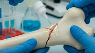 China cria cola óssea que repara fraturas em 3 minutos sem intervenção cirúrgica