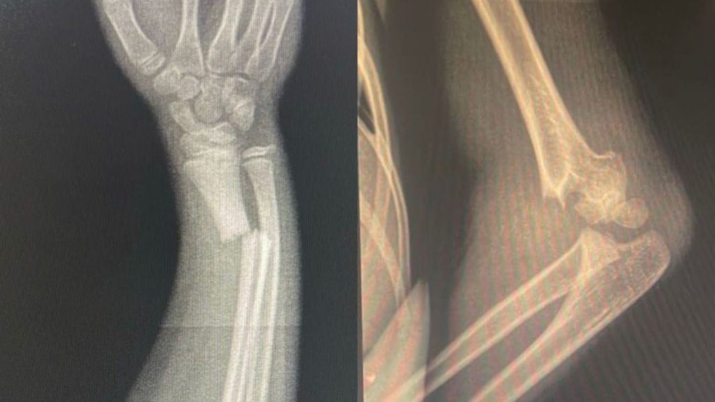 Várias crianças com fraturas graves foram operadas aqui mesmo — tratadas em hospital público e dentro da própria rede municipal. (Foto: Acervo pessoal)