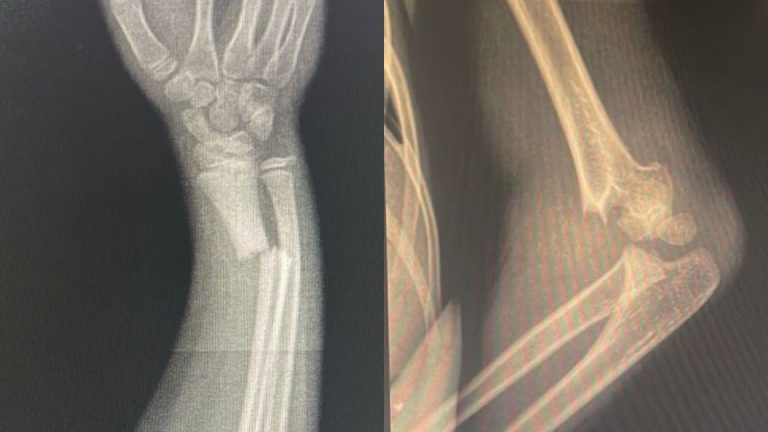 Várias crianças com fraturas graves foram operadas aqui mesmo — tratadas em hospital público e dentro da própria rede municipal. (Foto: Acervo pessoal)