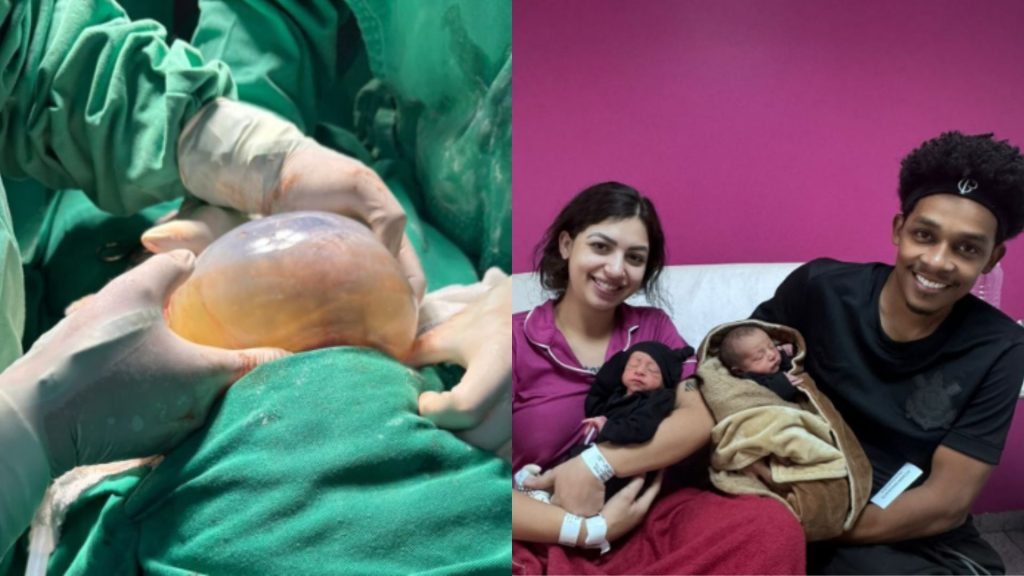 Gêmeo nasceu empelicado na Maternidade Dona Íris. (Foto: Divulgação)