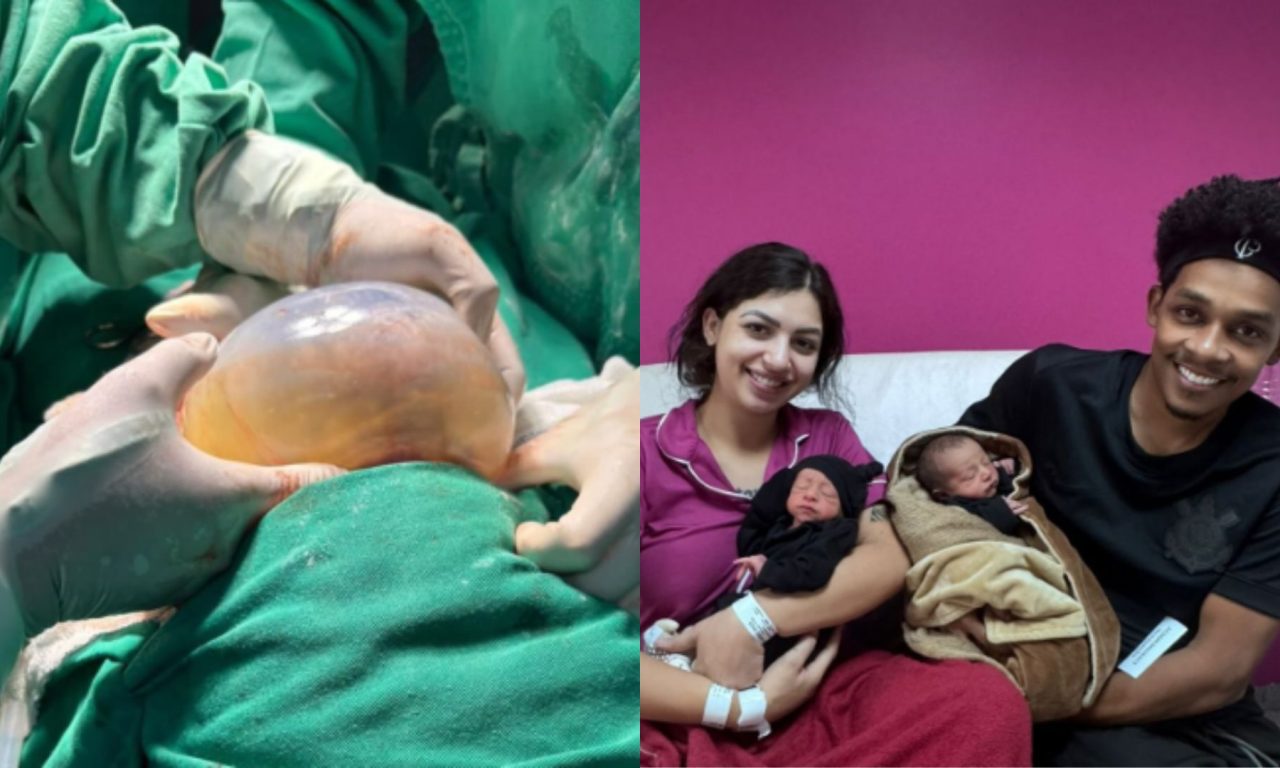 Gêmeo nasceu empelicado na Maternidade Dona Íris. (Foto: Divulgação)