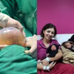 Gêmeo nasceu empelicado na Maternidade Dona Íris. (Foto: Divulgação)