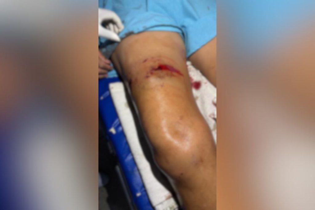 Mulher é atacada por pitbull em Aparecida de Goiânia e dono do animal arcará com despesas médicas