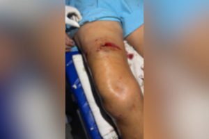 Mulher é atacada por pitbull em Aparecida de Goiânia e dono do animal arcará com despesas médicas