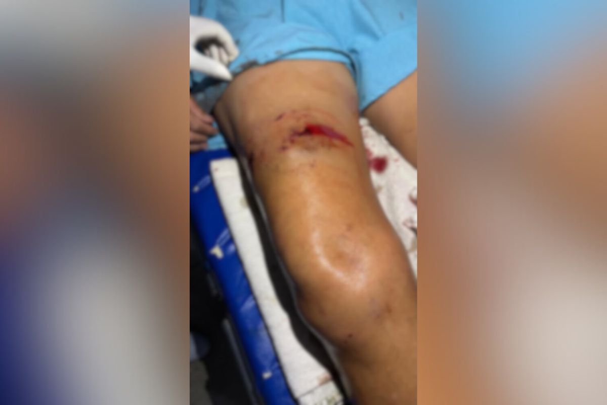 Mulher é atacada por pitbull em Aparecida de Goiânia e dono do animal arcará com despesas médicas