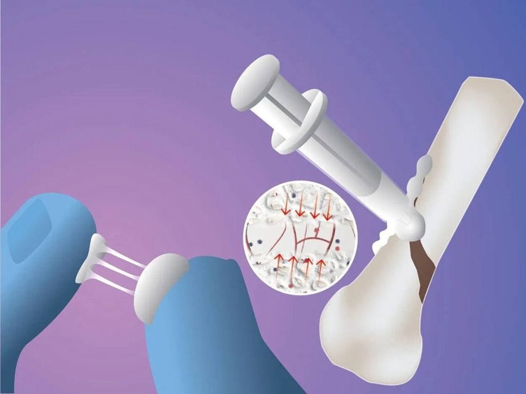 Pesquisadores chineses desenvolvem tecnologia capaz de reparar fraturas ósseas em apenas 3 minutos